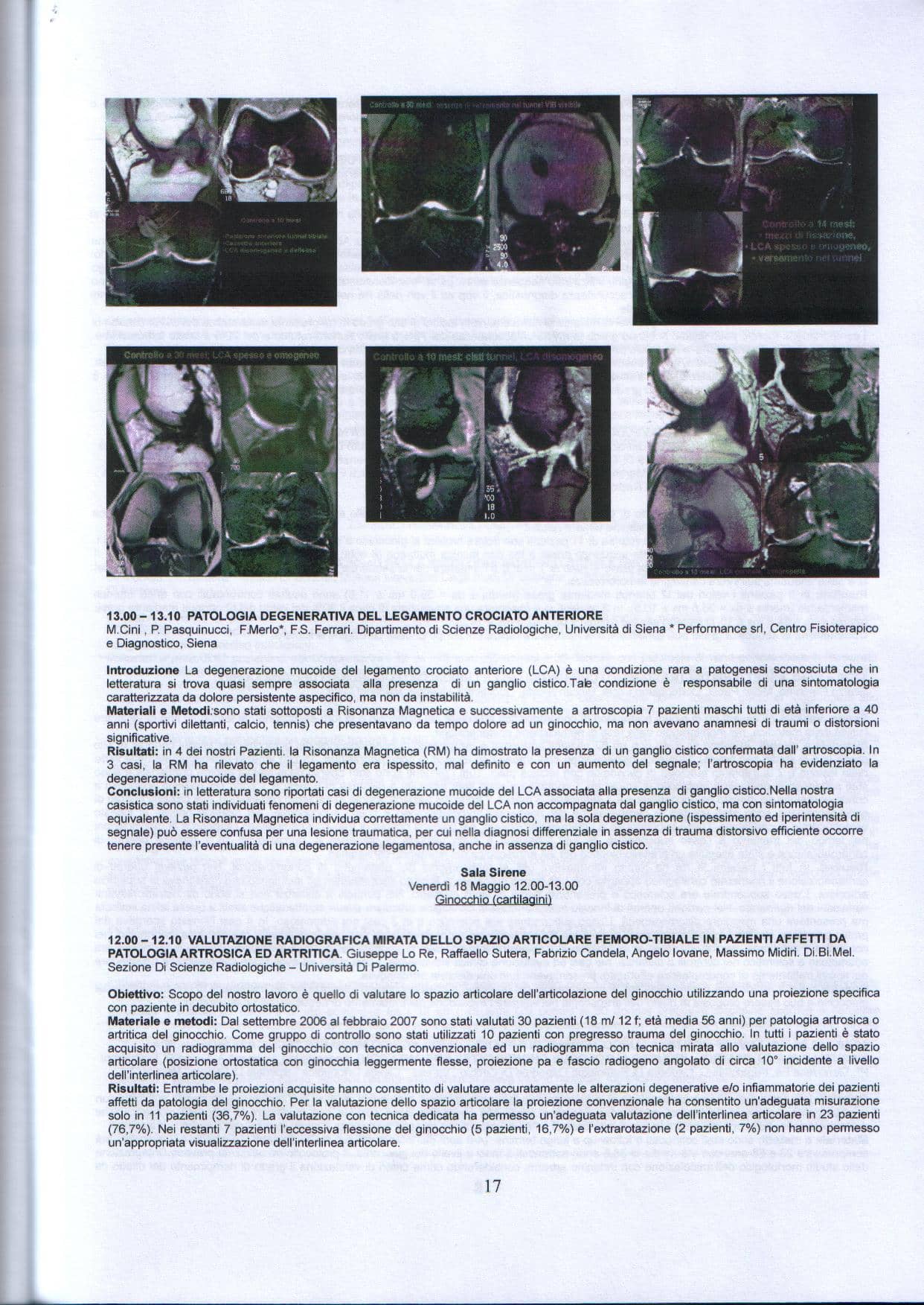 Piatto tibiale dolore e menisco